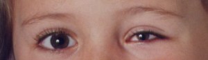 Enfant présentant une microphtalmie gauche avec colobome irien.